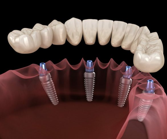 all on 4 dental implants recovery time
