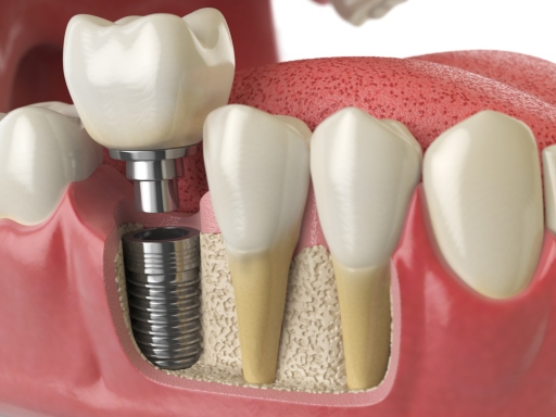 Important Tips for the Dental Implants Ever