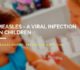 Measles - A Viral Infection in Children