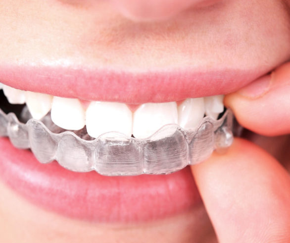 Cost for Invisible Braces